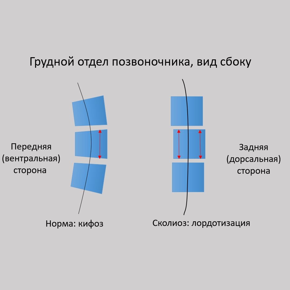Лордотизация грудного отдела позвоночника при сколиозе вследствие феномена относительно более выраженного роста передней части позвонка (от англ. RASO — relative anterior spinal overgrowth)