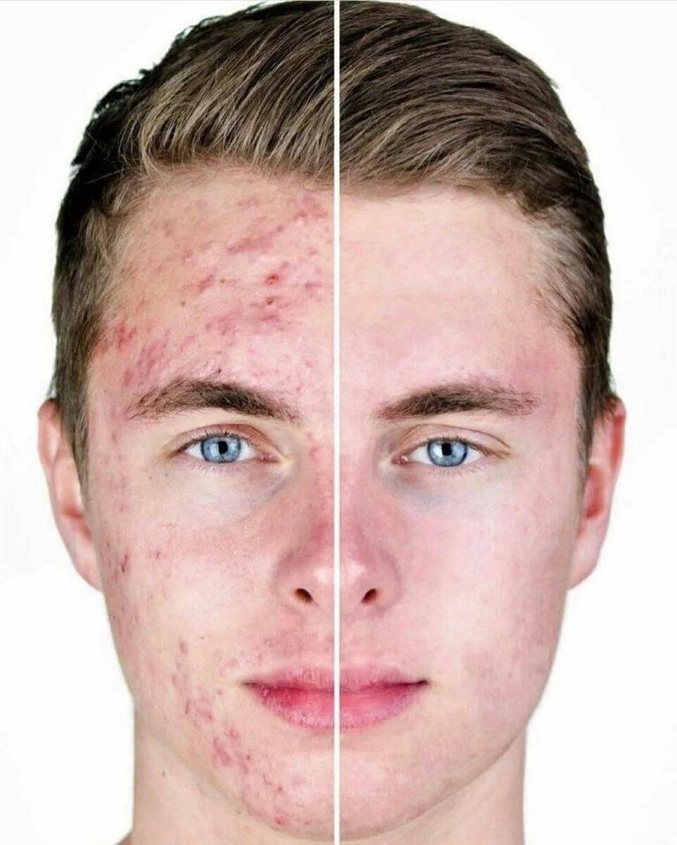 Акне на лице человека
