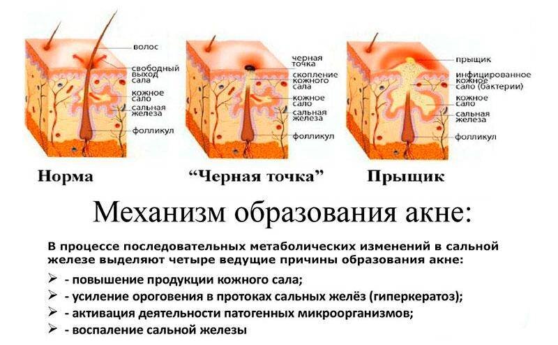 Что находится внутри прыщей на лице Акне,что это такое? DorMedicina Дзен