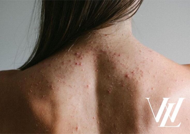 Акне на спине и плечах 