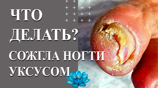 Кровоточивость родинки: это опасно?