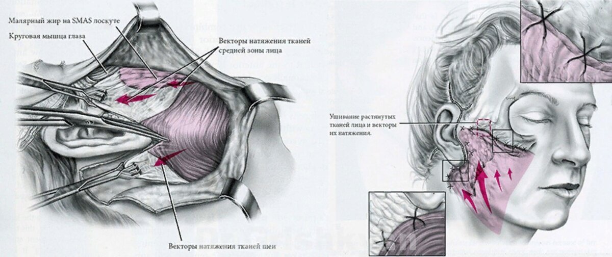 Схема подтяжка лица. Смас лифтинг схема операции. Схема операции смаслифтмнг. Круговая подтяжка схема. Круговая подтяжка лица схема.