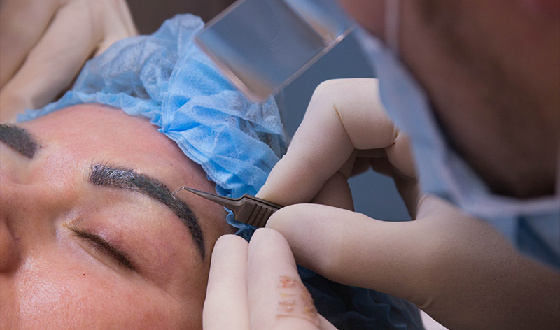 В моей практике были такие удивительные случаи: пациент выщипает брови, депилирует... а потом приходит на пересадку. Платит за процедуру немалые деньги... и продолжает по привычке выщипывать уже пересаженные дорогостоящие волоски! И так по кругу!