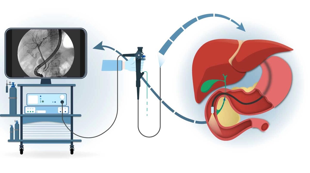 Что такое ЭРХПГ? Диагностика и лечение протоков печени и поджелудочной  железы | Mednavigator.ru | Дзен