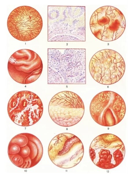 Варианты изменения слизистой при хроническом цистите.