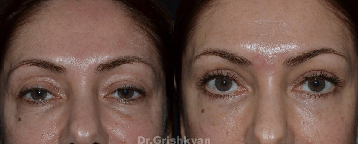 Провели блефаропластику для исправления складок и липофилинг нижних век. Фото до и после. Фото с сайта хирурга Д.Р. Гришкяна. Имеются противопоказания, требуется консультация специалиста