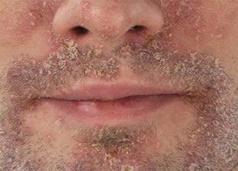 Дерматит на лице 