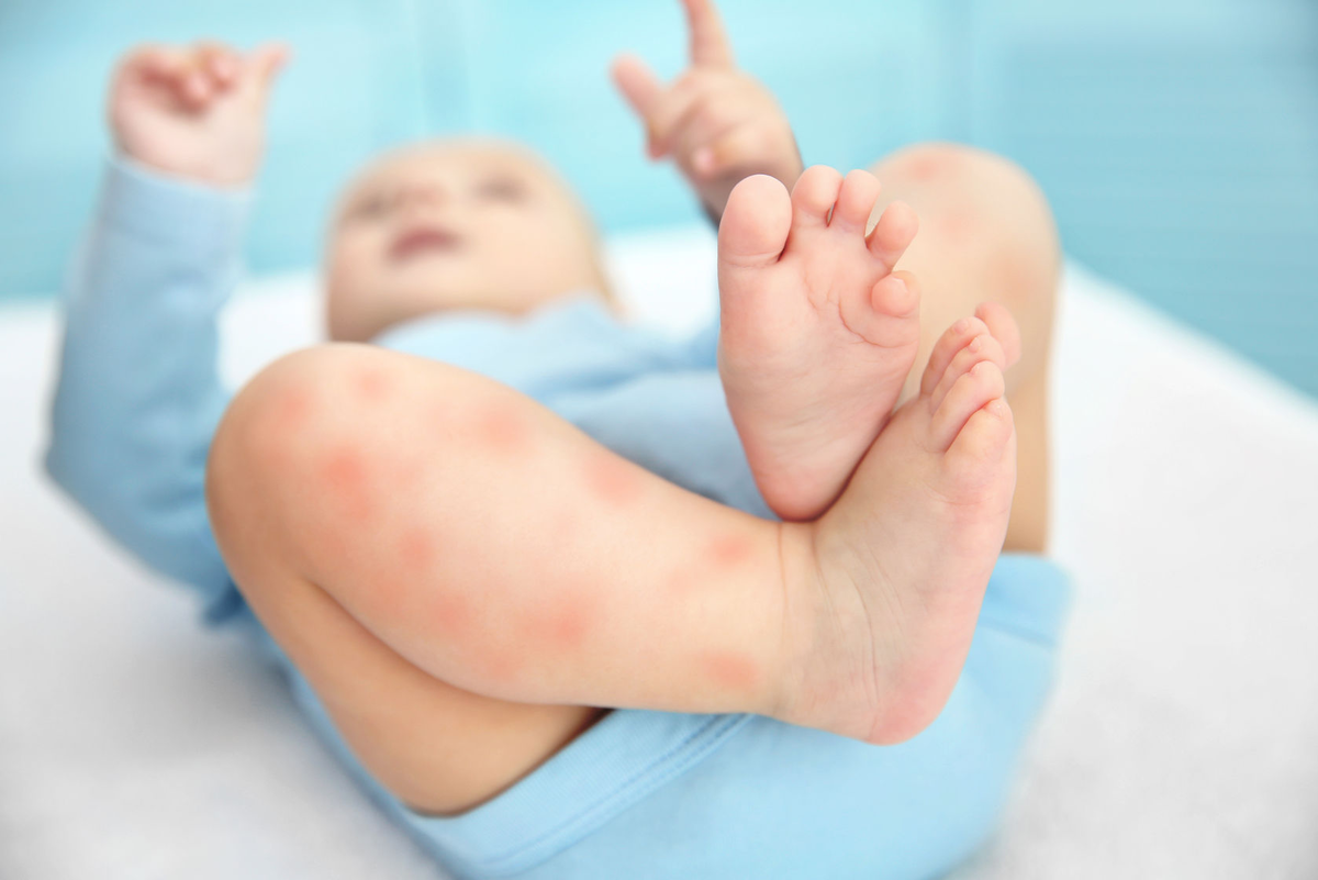 Атопич. Строфулюс атопический дерматит. Алегрия на ногах у ребенка. Аллергический дерматит на ножках у ребенка. Атопический дерматит на ногах у ребенка.