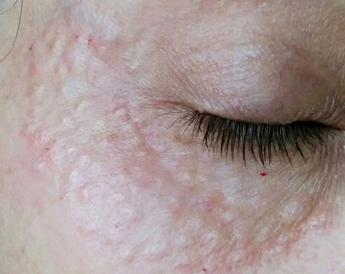 Глубина введения сыворотки и дозировка обсуждается заранее, а также зависит от уровня установленной проблемы.