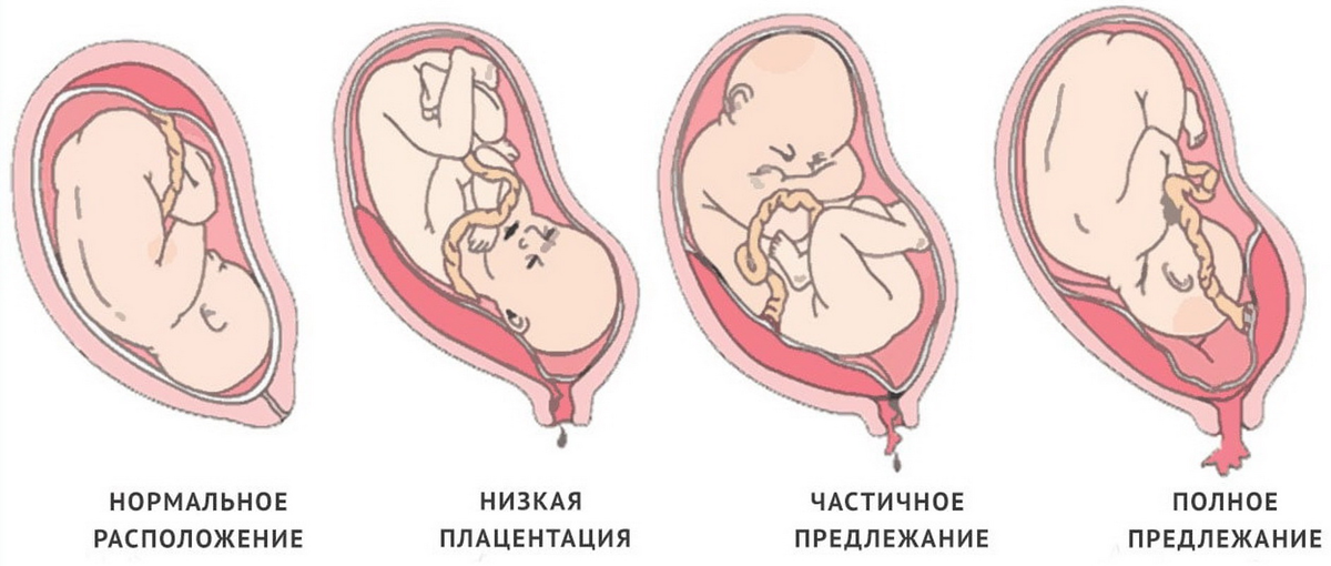 Может ли остеопат повернуть малыша, который лежит неправильно?