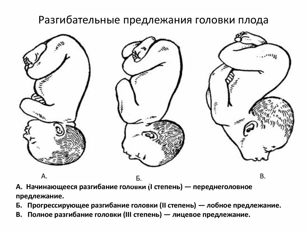 Неправильное положение плода картинки