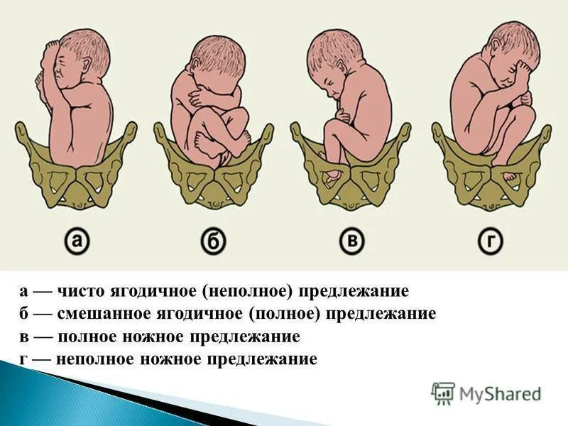 Тазовое предлежание плода. Как узнать, как лежит ребенок в животе