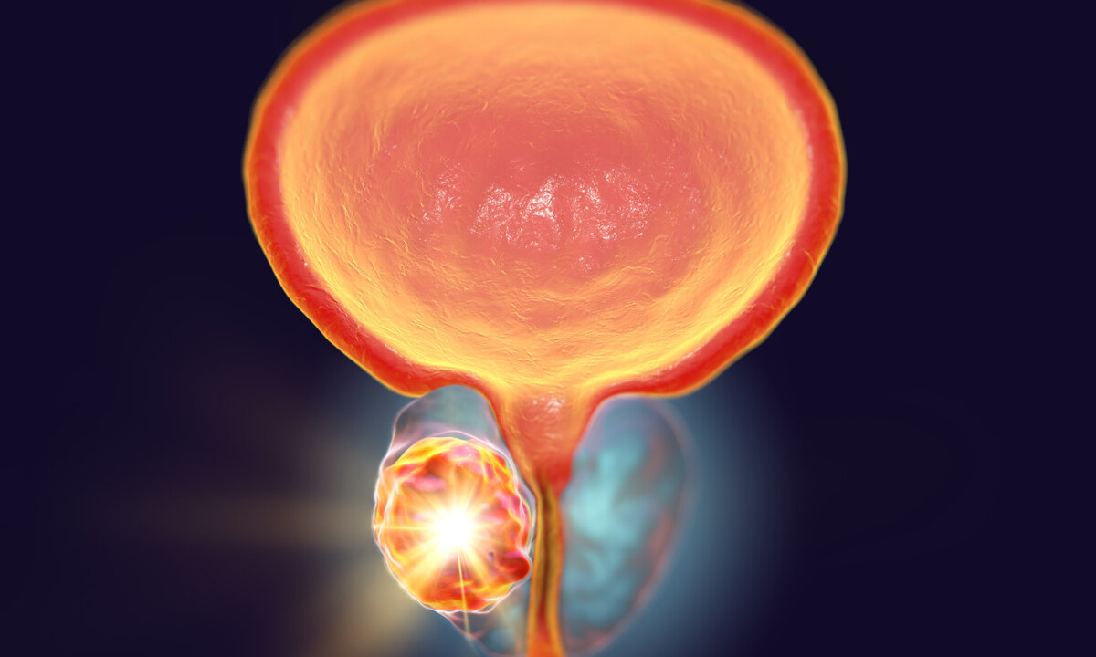 Аденома простаты: не так страшен черт… | Москва — столица здоровья | Дзен