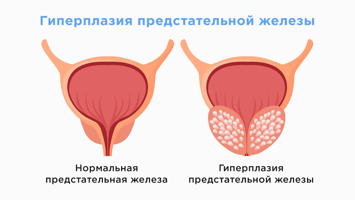 Последствия хронического простатита для мужчин