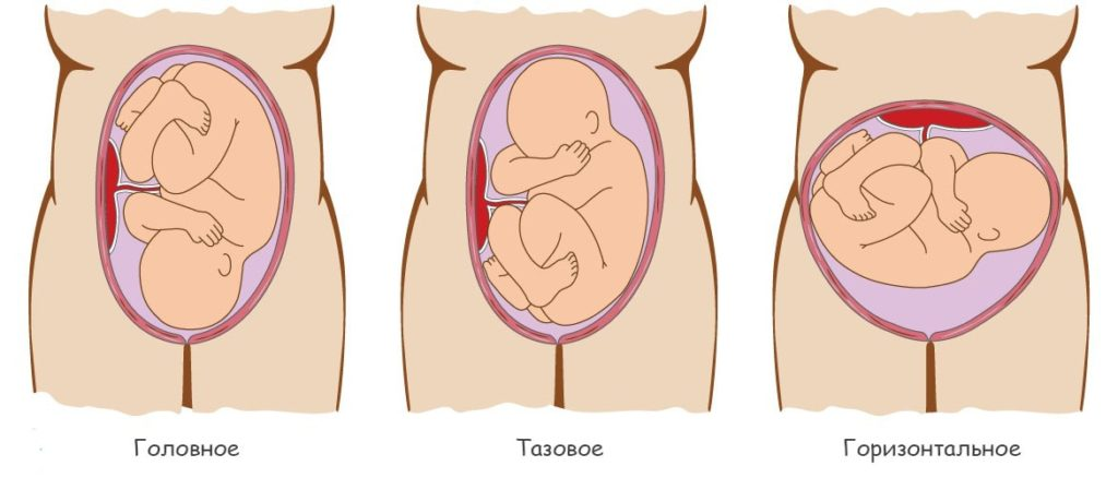 Головное и тазовое предлежание плода. Головковое предлежание плода. Головное предлежание плода при беременности. Головное предлежание плода на 23 неделе беременности. Четверо родов