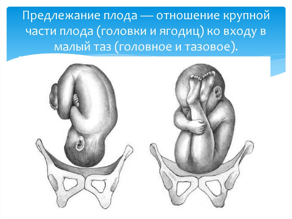 Предлежание плода картинки