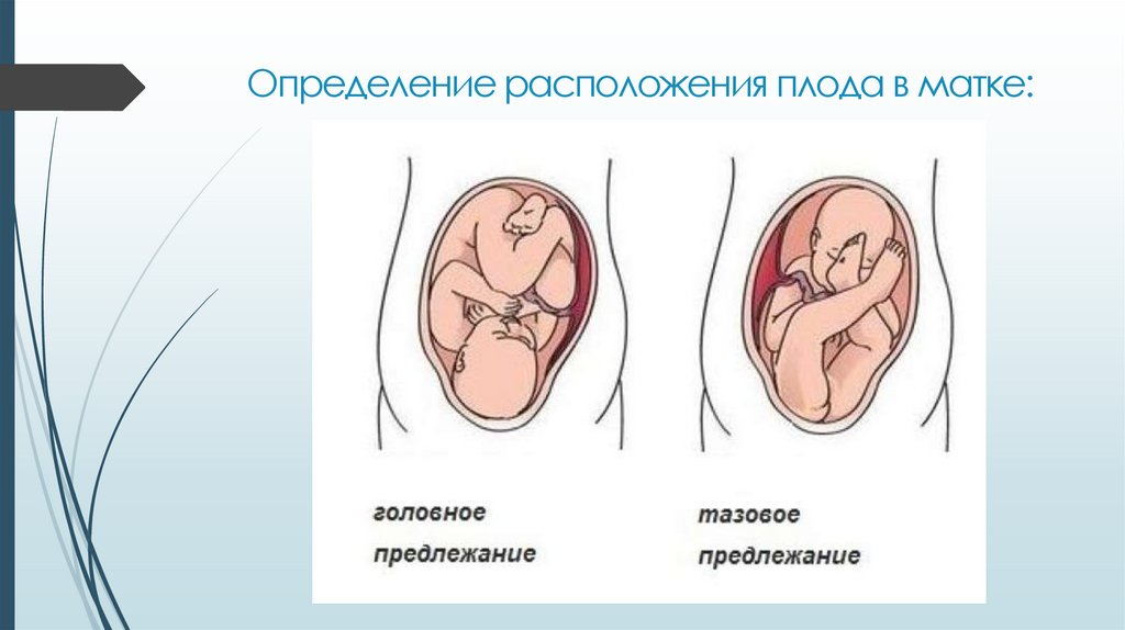 Расположение плода в полости матки