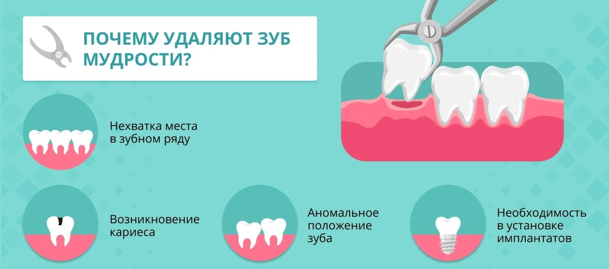 Можно ли удалить отзывы. Удалённый зуб мудрости. Удаленные зубы мудрости.