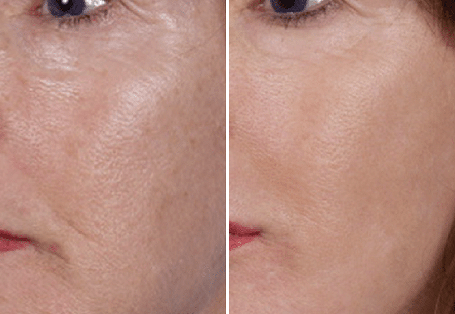 Шлифовка морщин. Пилинг Triple acid Skin Peel. Плазменная шлифовка кожи.