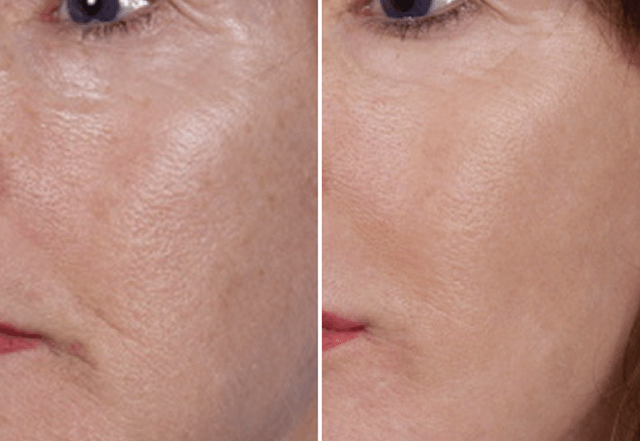 Пилинг Triple acid Skin Peel. Лазерная наноперфорация постакне.