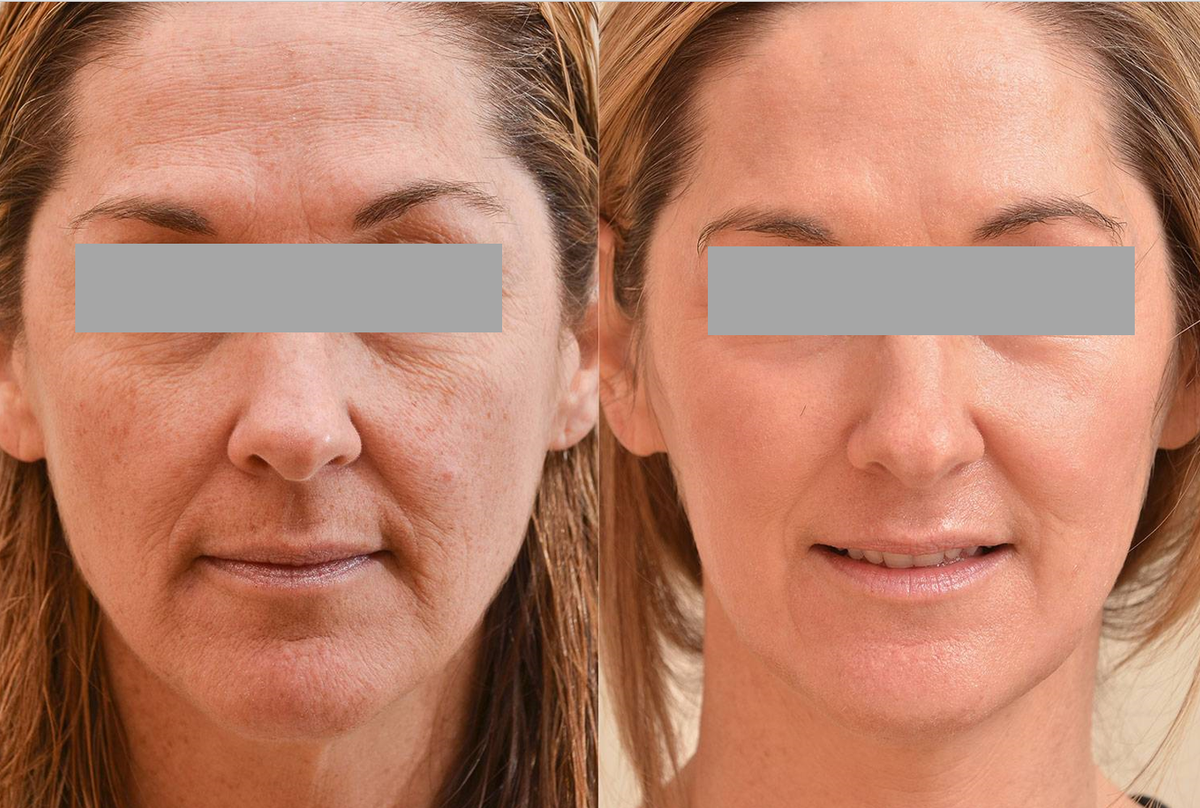 Эффект от микронидлинга c использованием набора XMEZO ANTI-AGE CARE