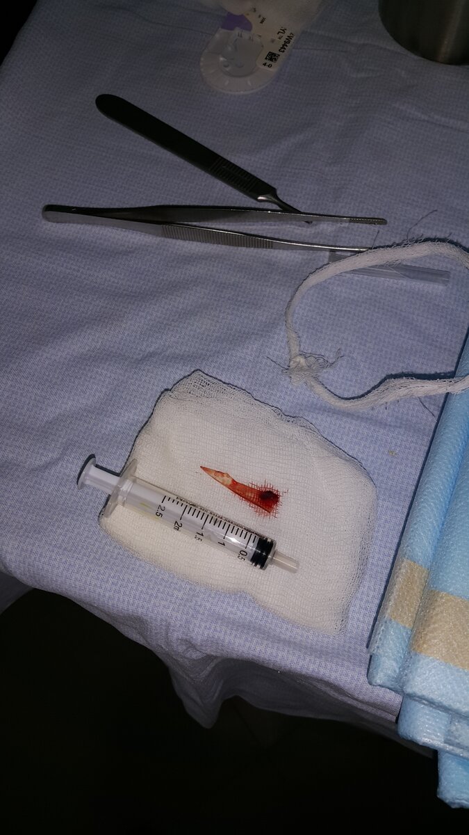 То самое инородное тело, от которого пострадал. Сразу после извлечения.