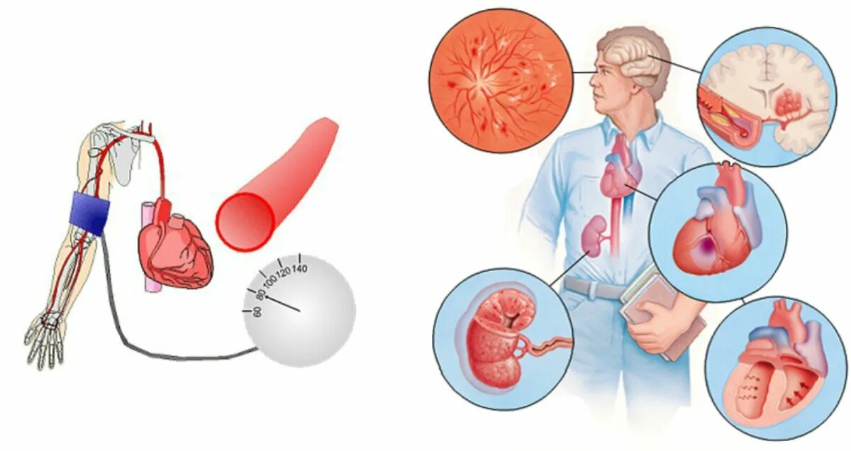 Вторичные артериальные гипертензии