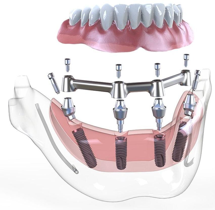 мостовидный протез 4 зуба на 2 имплантах. аттачмент osstem. зубной протез верхней челюсти на 4 имплантах. балочный протез на 4 имплантах. сколько будет стоить челюсть на имплантах.