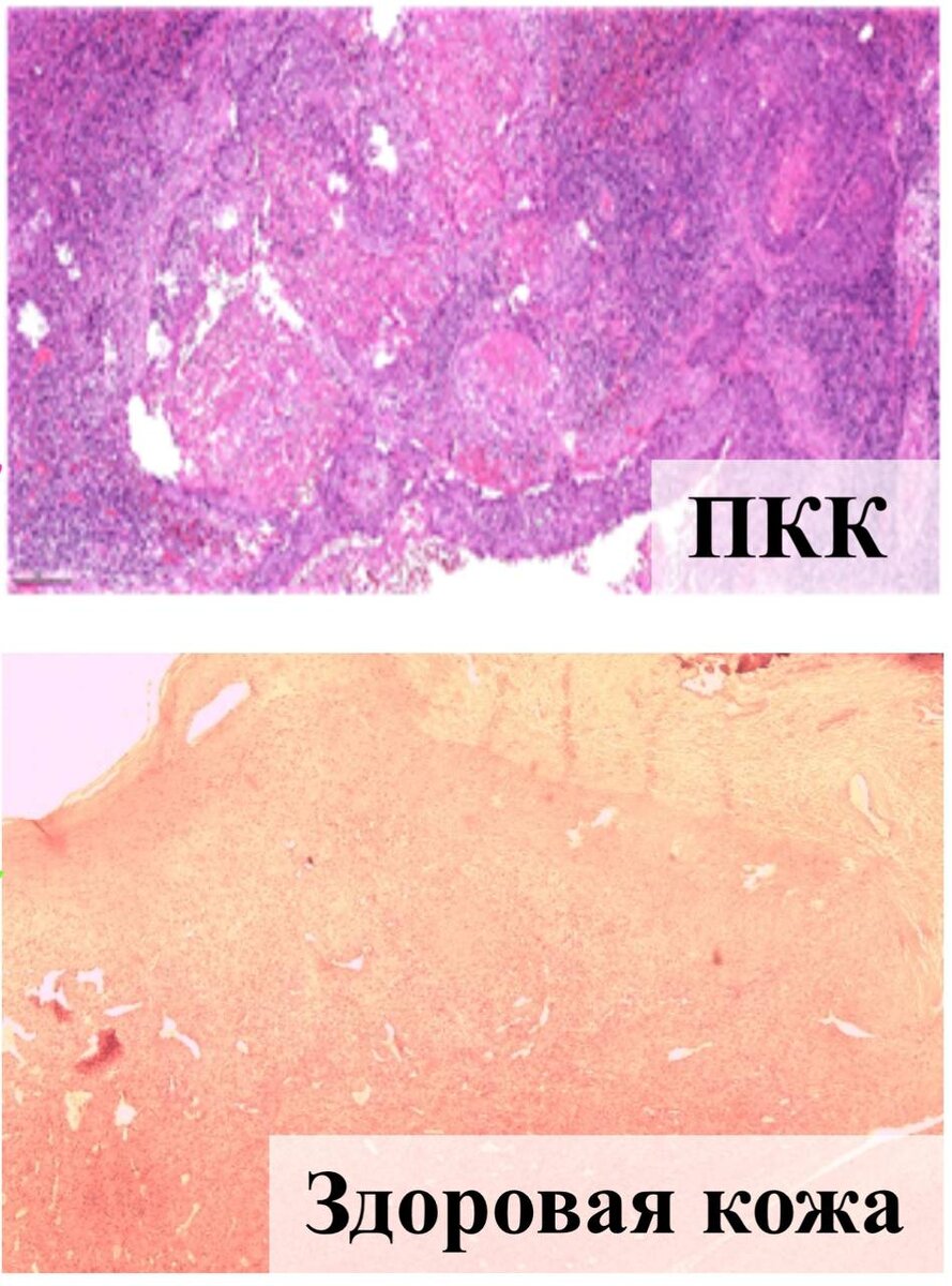 Фотографии (под микроскопом) здоровой кожи и плоскоклеточной карциномы. Источник: Елена Римская