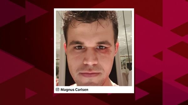 Чемпион мира с повреждением глаза