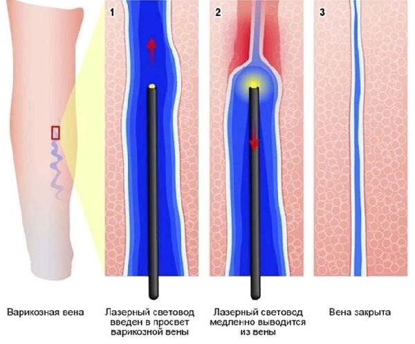 Принцип воздействия на сосуд при ЭВЛК