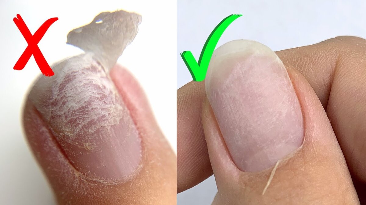 Ногти перед операцией. Содранное покрытие с ногтей. Ногти после самостоятельного снятия гель лака.