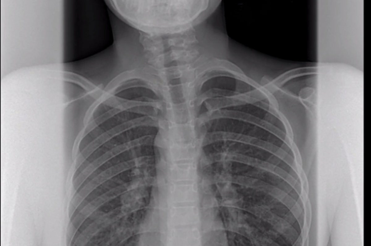    Врачи в Уфе спасли ребенка от инвалидности, исправив врожденную кривошею