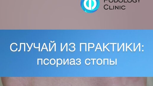 КЛИНИКА ПОДОЛОГИИ ПОЛЁТ | СЛУЧАЙ ИЗ ПРАКТИКИ: псориаз стопы ...