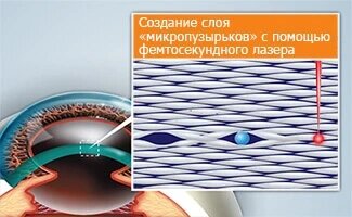 На фото: Процесс операции методом Femto-LASIK
