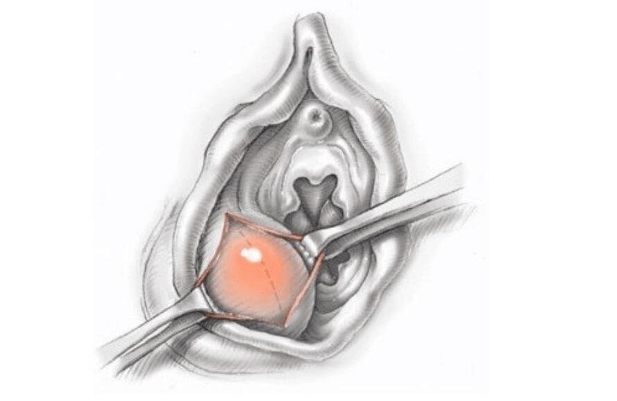 Киста бартолиновой железы