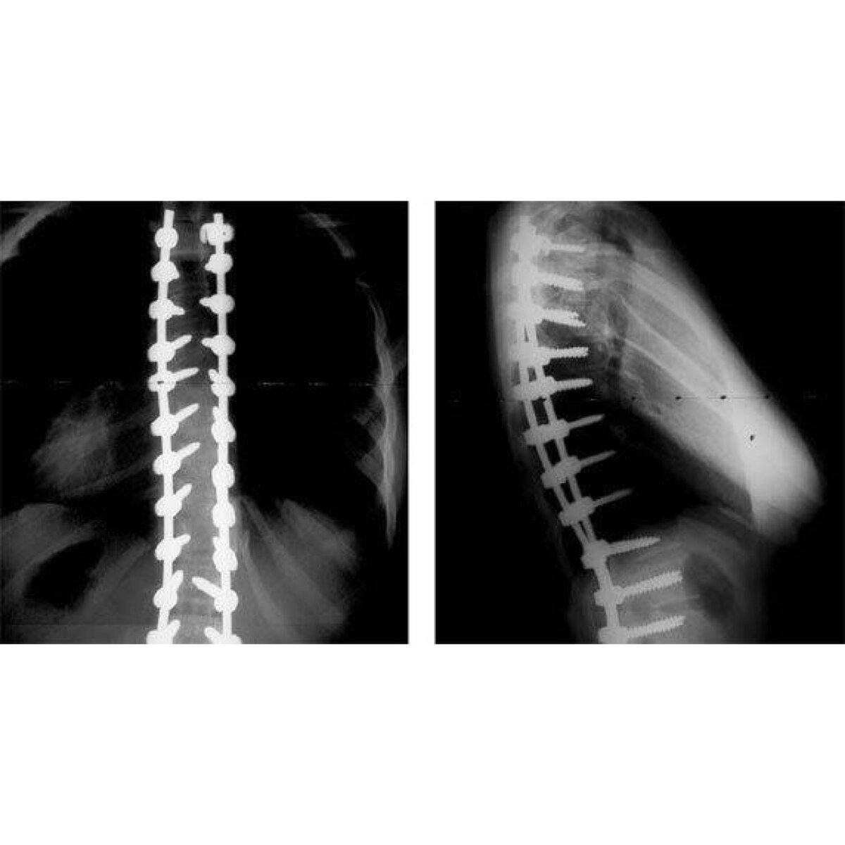 Сколиоз кто лечит какой. Сколиоз после операции рентген. 2-Х пластинчатый эндокорректор. Рентгенограмма коррекции сколиоза 2-х пластинчатым эндокорректором. 2-Х пластинчатый эндокорректор рентген.