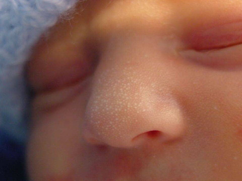 Прыщики на лице малыша: виды, причины, устранение