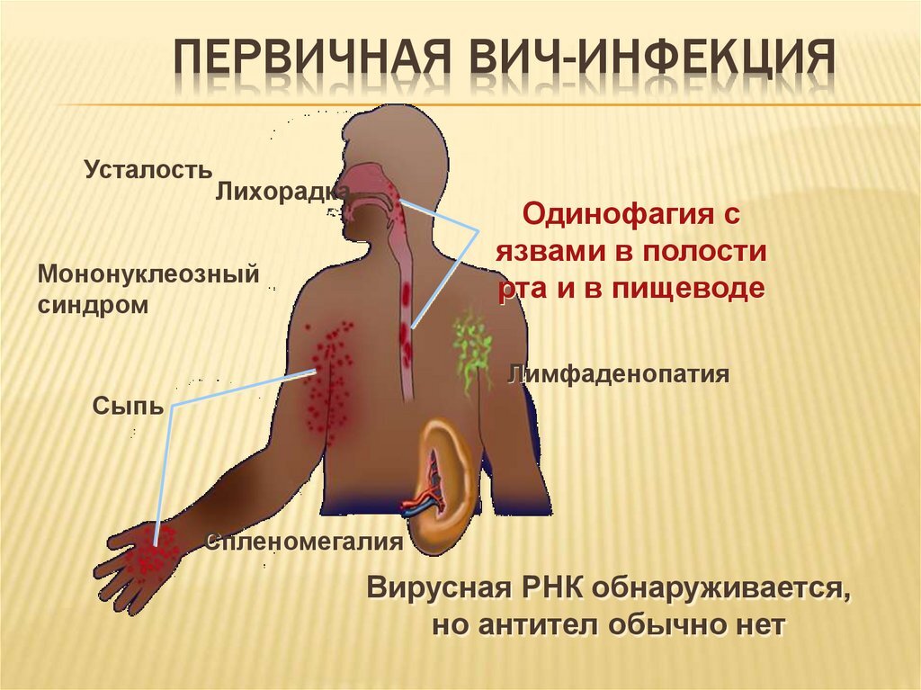 Клиническая картина вич инфекции спид