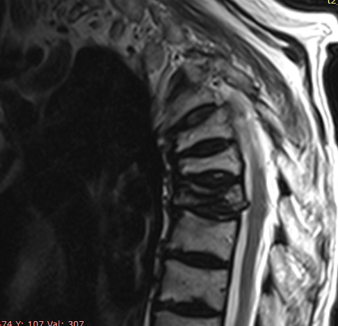МРТ грудного отдела: компрессионный перелом ТН 6,7, 8 позвонков – Т2 режим.                    Режим STIR – указал о свежем характере перелома в 8-ом грудном позвонке.
