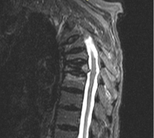 МРТ грудного отдела: компрессионный перелом ТН 6,7, 8 позвонков – STIR режим.