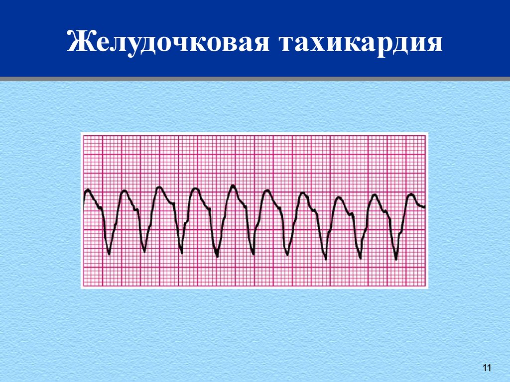 Наджелудочковая тахикардия