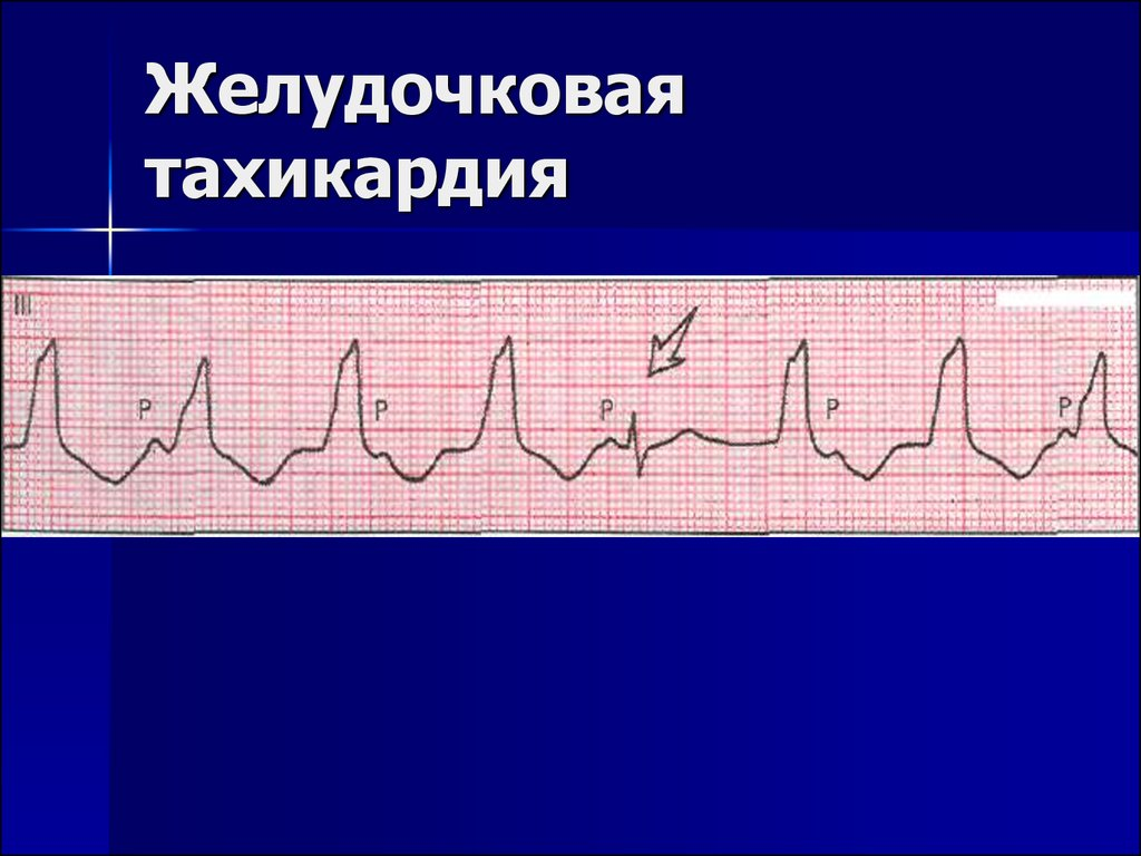 Лечение желудочковой тахикардии. Пароксизмальная желудочковая тахикардия на ЭКГ. Желудочковая тахикардия на ЭКГ. ЭКГ при желудочковой тахикардии. Тахикардия желудочков на ЭКГ