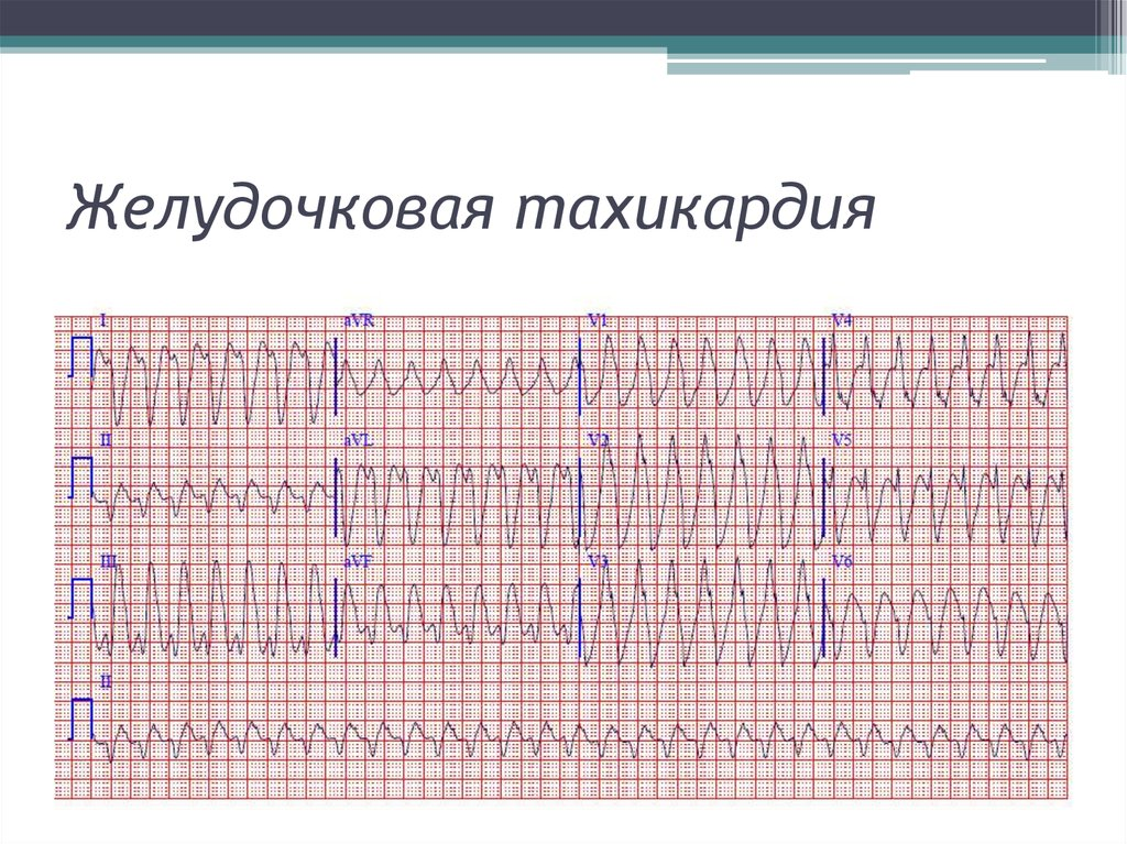 Желудочковая тахикардия лечение. Пароксизмальная тахикардия желудочков ЭКГ. Пароксизмальные неустойчивые желудочковые тахикардии ЭКГ. ЖТ тахикардия на ЭКГ. Желудочковая тахикардия на ЭКГ.