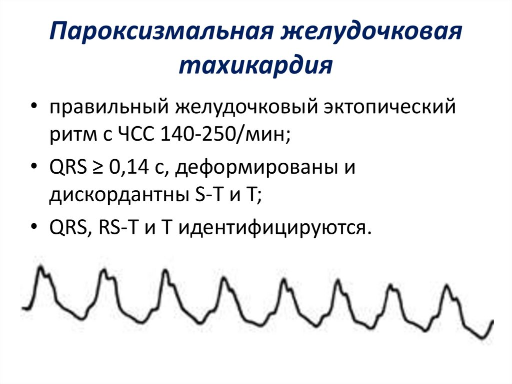 Причины тахикардии у мужчин. Трепетание предсердий 2 к 1 на ЭКГ. Трепетание предсердий ЭКГ критерии. Правильная форма трепетания предсердий на ЭКГ. Пароксизмальная желудочковая тахикардия на ЭКГ.