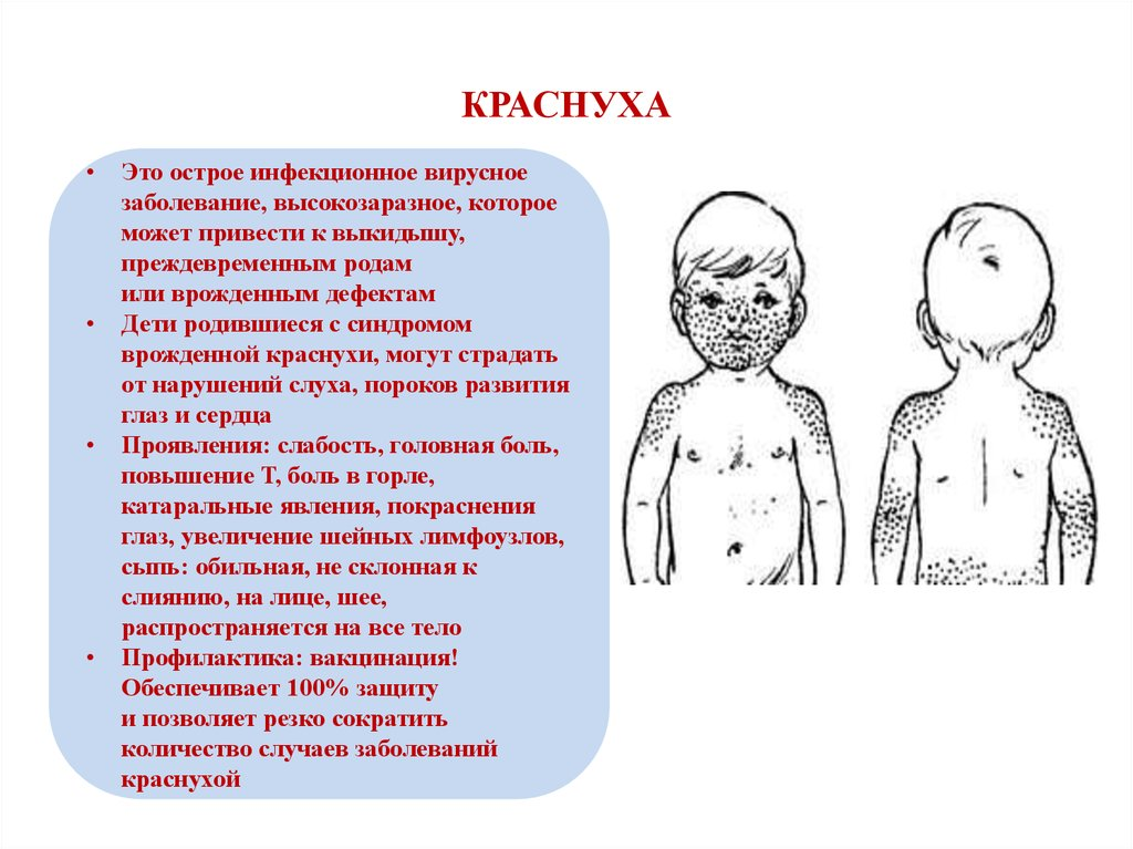 Корь у привитых взрослых. Краснуха локализация сыпи у детей. Проявление краснухи у детей.