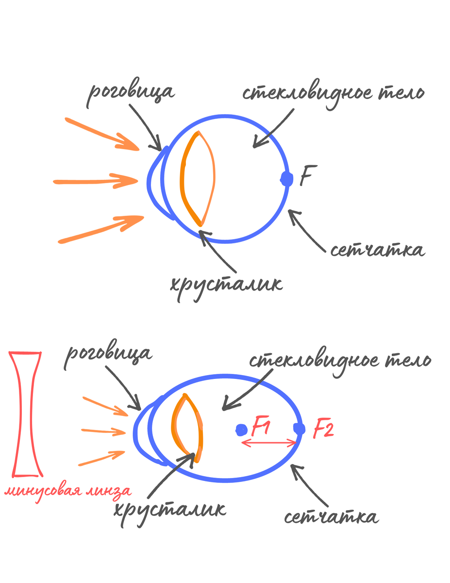 Механизм коррекции миопии с помощью "минусовой" линзы, где рассеивающая линза как бы ослабляет слишком сильное преломление и отодвигает фокус обратно на сетчатку глаза 