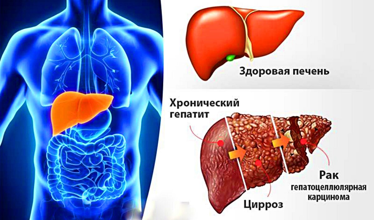 Хронический гепатит картинка