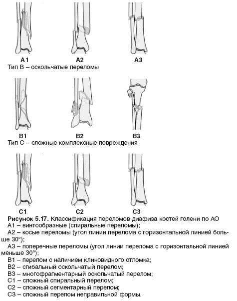 Переломы большеберцовой кости классификация. Классификация диафизарных переломов костей голени. Классификация переломов диафиза бедренной кости по АО. Переломы костей голени классификация.