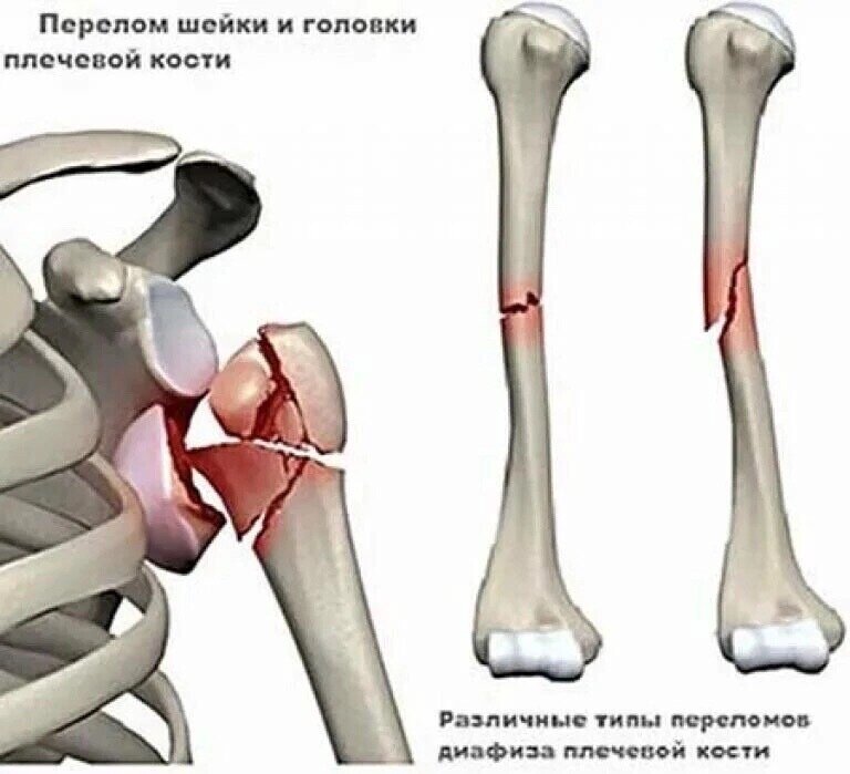 Перелом плечевой кости. Перелом диафиза плечевой кости. Оскольчатый перелом плечевой кости. Перелом плечевой кости мкб. Переломы диафиза плечевой кости симптомы.